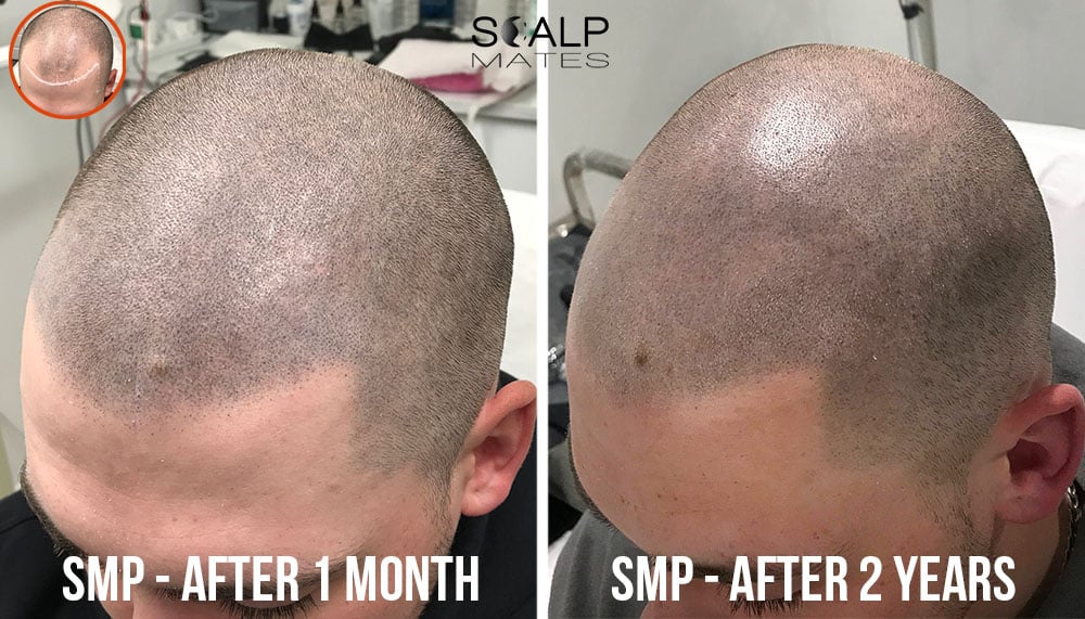 Scalp micropigmentation healed results showing 1 month versus 2 years retention for male scalp tattoo in Birmingham
