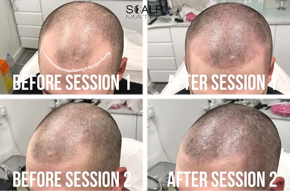 Step by step scalp tattoo treatment showing hairline density progression across session 1 and session 2