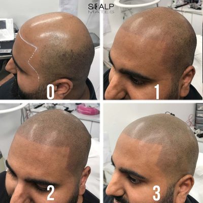 Step by step session progression from mapping line 0 to session 3 sharp hairline SMP