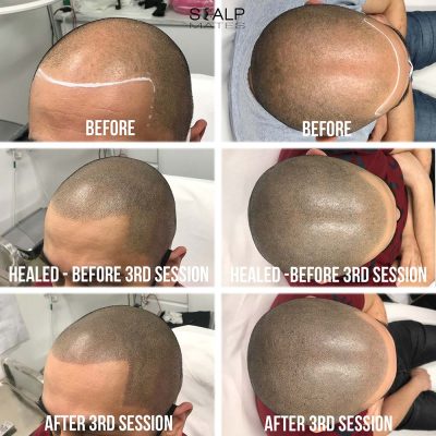 step-by-step progression of Norwood 5 soft to sharp hybrid hairline scalp micropigmentation in Birmingham