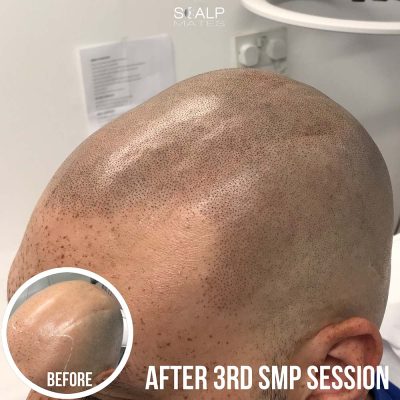Top-down view of a soft feathered scalp micropigmentation hairline and full balding crown coverage on a bald mixed race male client following 3 SMP sessions at ScalpMates.