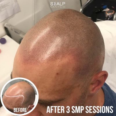 shaved hair balding solution birmingham uk, hair tattoo, smp, scalp micropigmentation for fair skin soft natural hairline