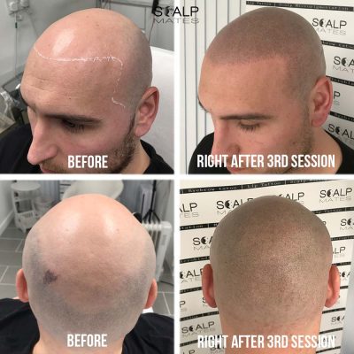 Shaved look scalp micropigmentation before and 3 sessions healed result in Birmingham
