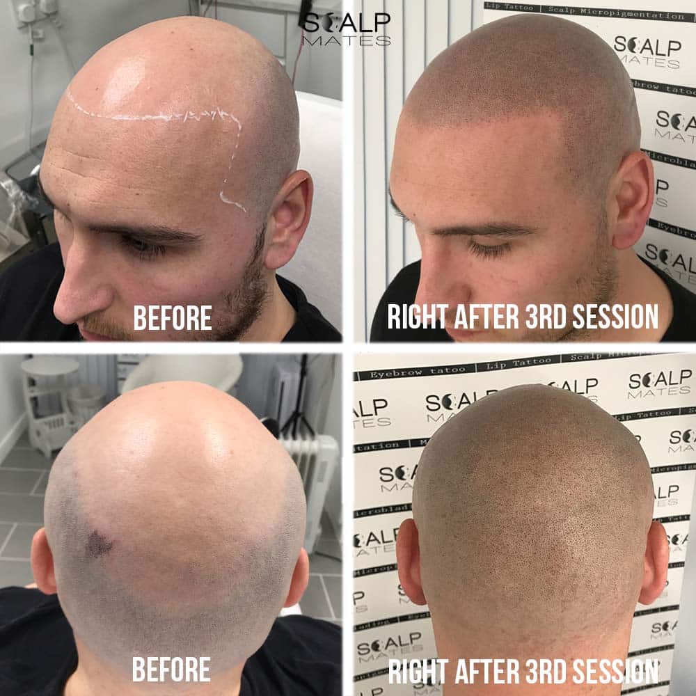 Shaved look scalp micropigmentation before and 3 sessions healed result in Birmingham