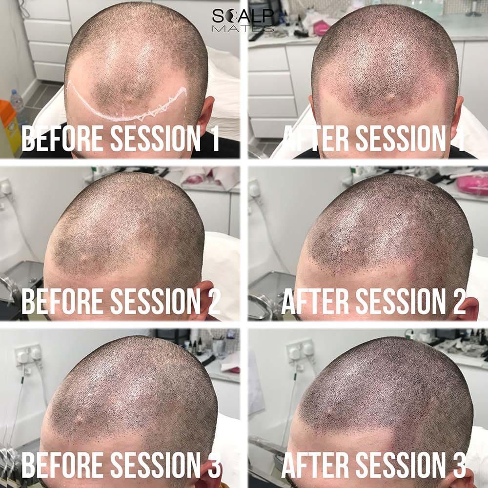 Full 3 session shaved look scalp micropigmentation process showing before treatment to final density result