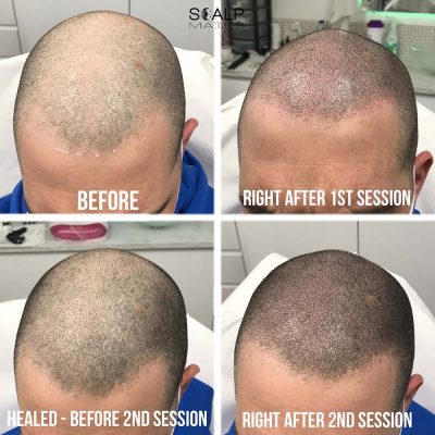 Front view of 2-session scalp micropigmentation for diffuse thinning before and after, showing a natural un-sharpened hairline and density restoration at ScalpMates Kings Heath, Birmingham