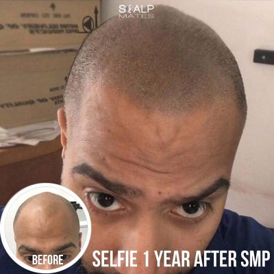 selfie 1 year after shaved look scalp micropigmentation treatment at Scalp Mates Birmingham