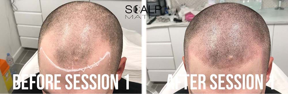 Before and after first session scalp micropigmentation hairline tattoo outlining shaved head density in Birmingham