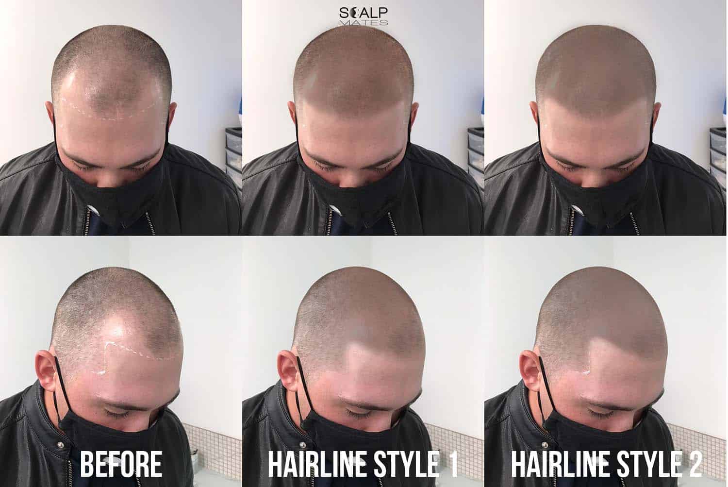 Virtual scalp micropigmentation hairline mockup options showing soft feathered and sharp hairline tattoo styles