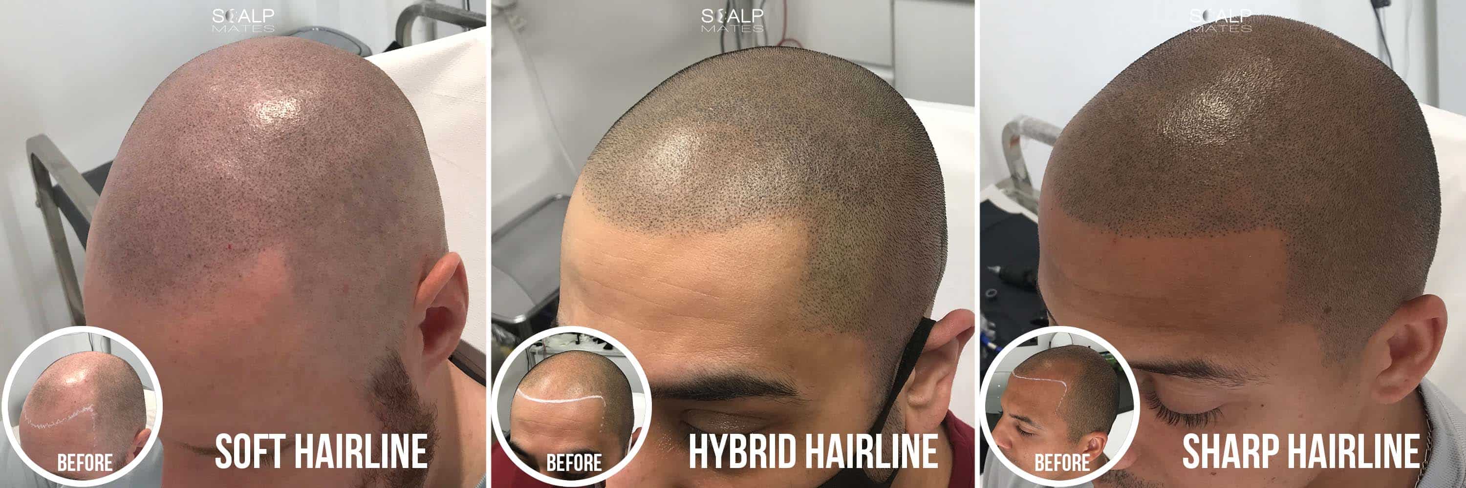comparison soft feathered hairline tattoo white man vs hybrid hairline tattoo on asian male vs sharp shape-up hairline tattoo on black man for bald males