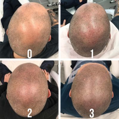 Top view 4-stage progression of whole head scalp micropigmentation from session 0 to session 3